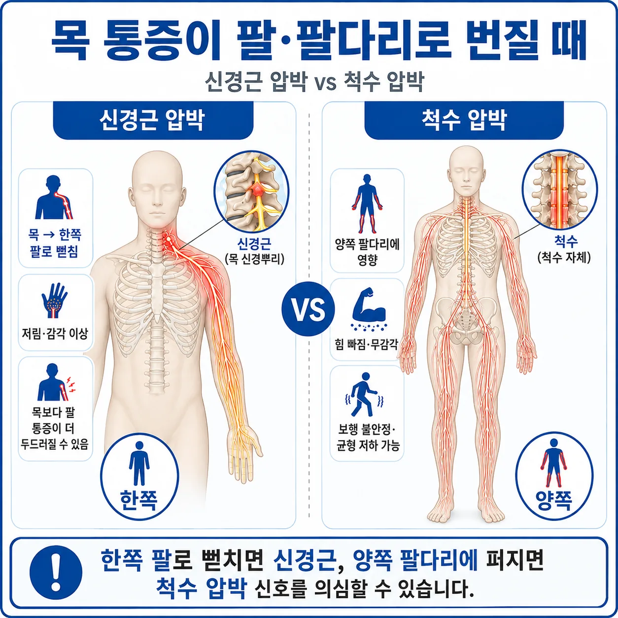 신경근 압박으로 한쪽 팔에 증상이 생기는 경우와 척수 압박으로 양쪽 팔다리에 증상이 생기는 경우를 비교한 도해