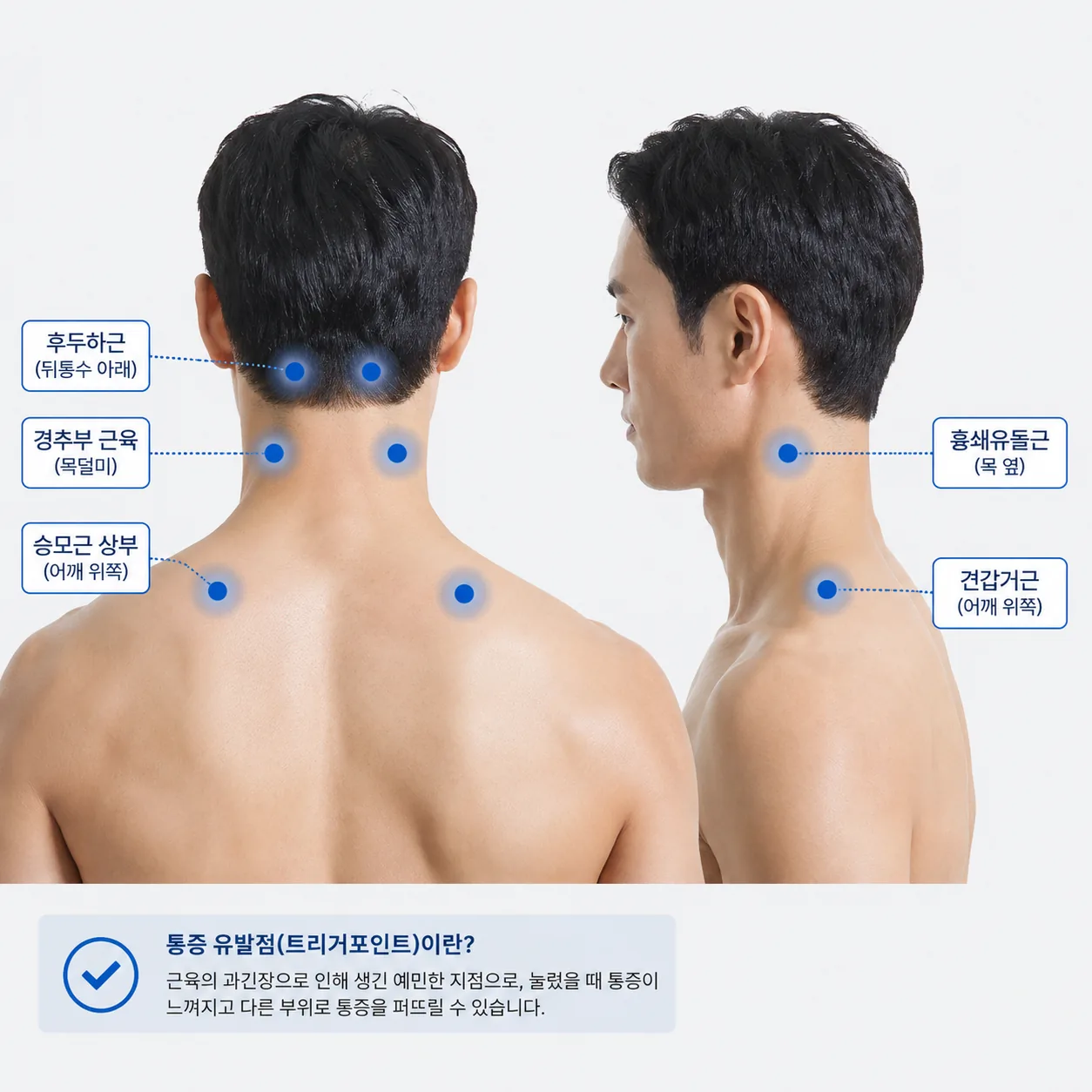 담 결렸을 때 통증 유발점이 흔히 잡히는 목덜미와 어깨 부위 표시 그림
